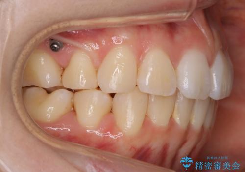 【再矯正】後戻りによるガタつきをマウスピースで改善!の治療前