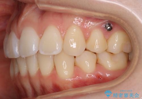 【再矯正】後戻りによるガタつきをマウスピースで改善!の治療後