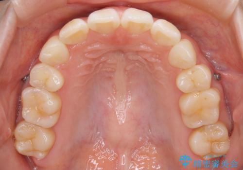 【再矯正】後戻りによるガタつきをマウスピースで改善!の治療後