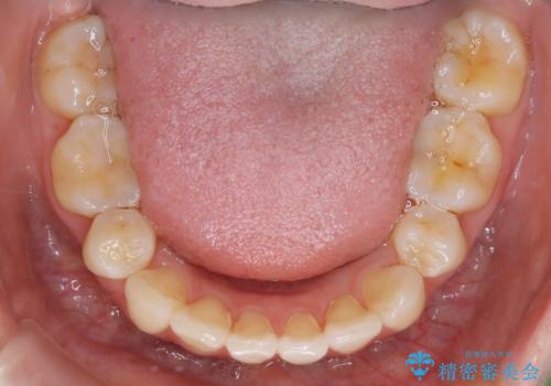 【再矯正】後戻りによるガタつきをマウスピースで改善!の治療後