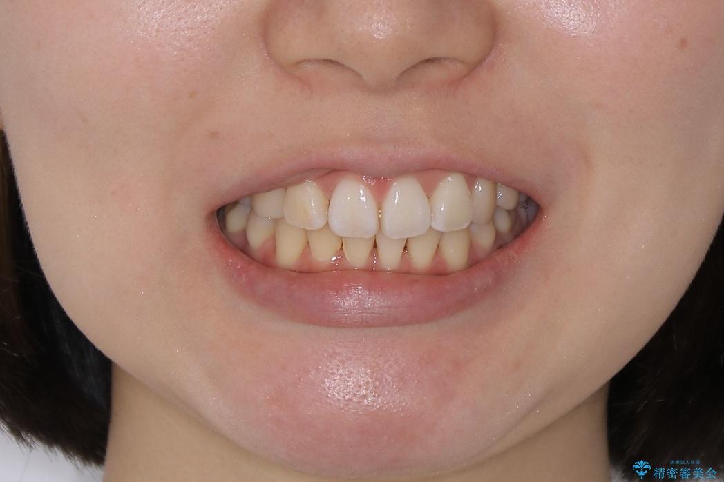 【再矯正】後戻りによるガタつきをマウスピースで改善!の治療後(顔貌)