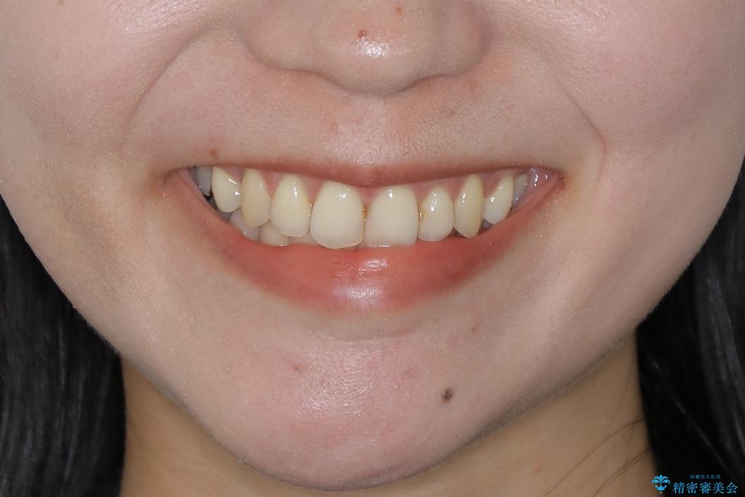 【抜歯】前歯のガタつきを改善　抜歯矯正で口腔内をスッキリさせるの治療後（顔貌）