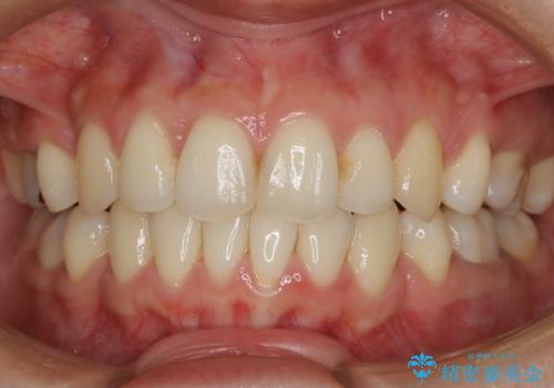 【抜歯】前歯のガタつきを改善　抜歯矯正で口腔内をスッキリさせるの症例 治療後