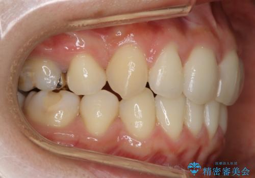 【抜歯】前歯のガタつきを改善　抜歯矯正で口腔内をスッキリさせるの治療後