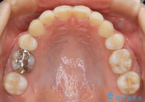【抜歯】前歯のガタつきを改善　抜歯矯正で口腔内をスッキリさせるの治療後