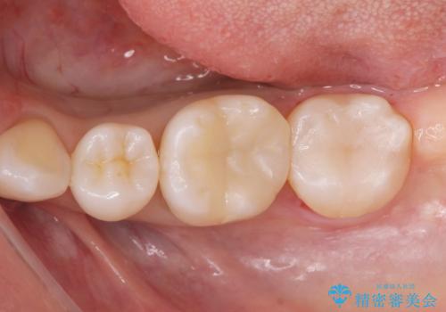 メタルの詰め物が取れたの症例 治療後