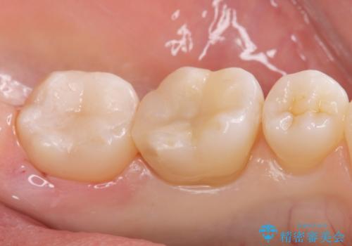 メタルの詰め物が取れたの治療後