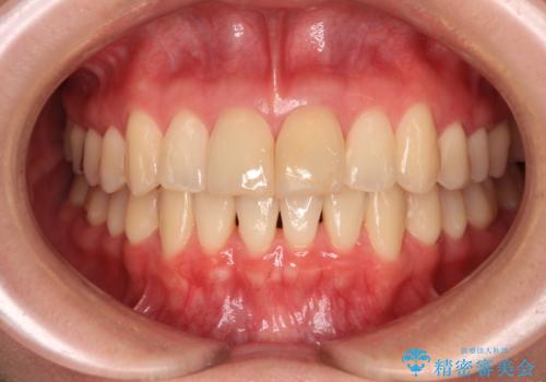 変色した前歯 オールセラミッククラウンにより審美歯科治療の治療前