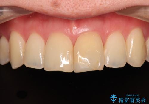 変色した前歯　オールセラミッククラウンにより審美歯科治療の症例 治療前
