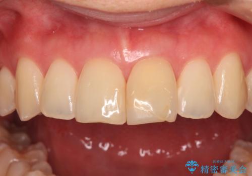 変色した前歯 オールセラミッククラウンにより審美歯科治療の治療前