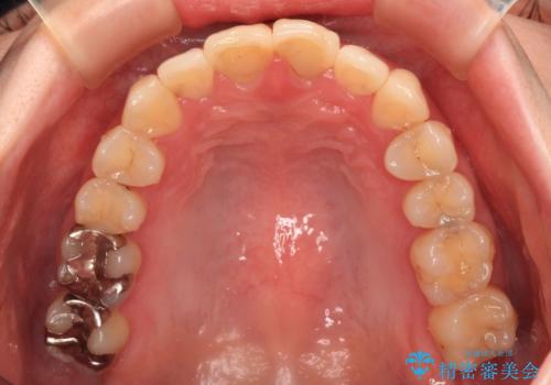 変色した前歯 オールセラミッククラウンにより審美歯科治療の治療前