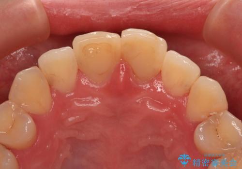 変色した前歯 オールセラミッククラウンにより審美歯科治療の治療前