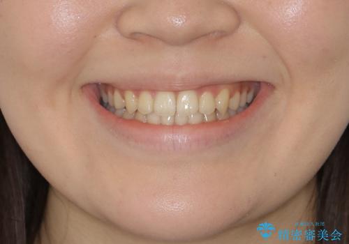 【非抜歯】すきっ歯と噛み合わせの治療