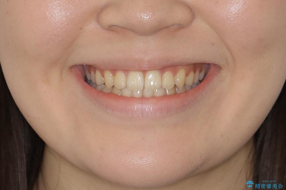 【非抜歯】すきっ歯と噛み合わせの治療の治療後（顔貌）