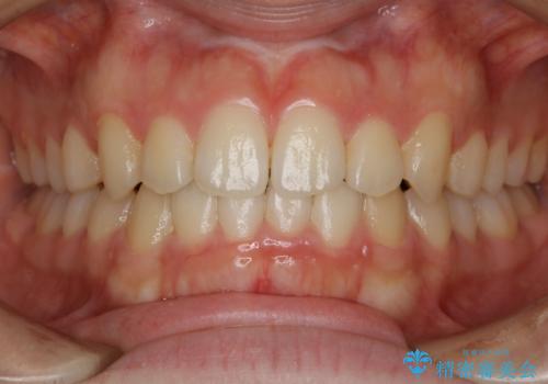 【非抜歯】すきっ歯と噛み合わせの治療の症例 治療後