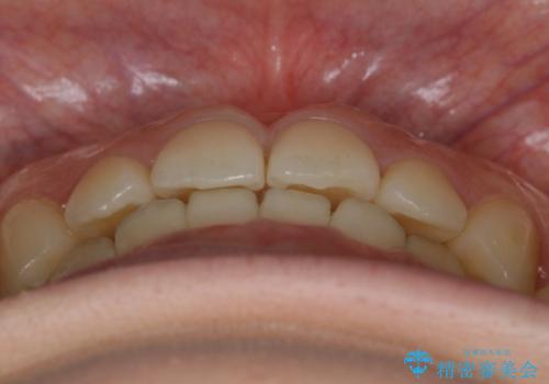【非抜歯】すきっ歯と噛み合わせの治療の治療後