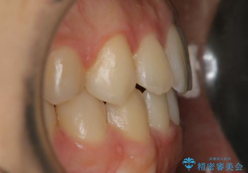 【非抜歯】すきっ歯と噛み合わせの治療の治療後