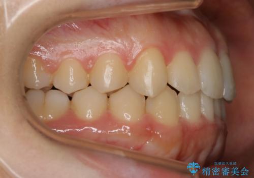 【非抜歯】すきっ歯と噛み合わせの治療の治療後