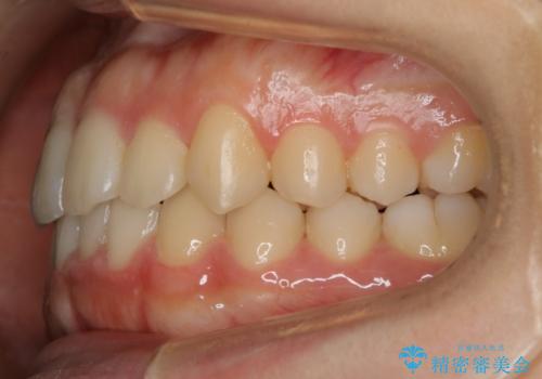 【非抜歯】すきっ歯と噛み合わせの治療の治療後