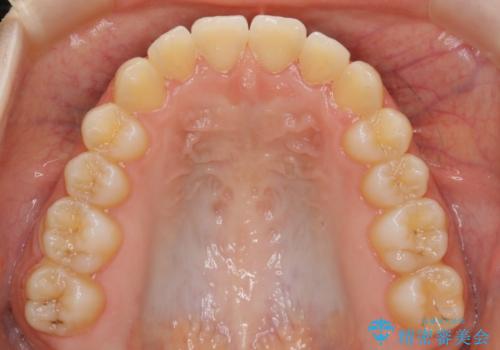 【非抜歯】すきっ歯と噛み合わせの治療の治療後