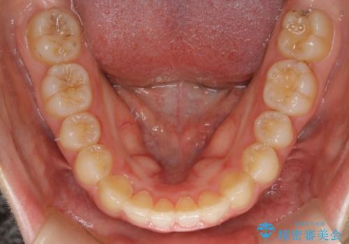 【非抜歯】すきっ歯と噛み合わせの治療の治療後