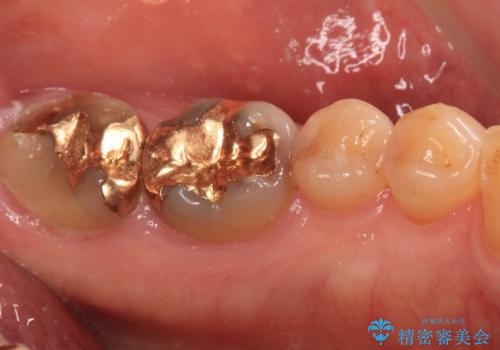 欠けてしまった奥歯のむし歯治療の治療前