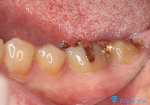 欠けてしまった奥歯のむし歯治療の治療前