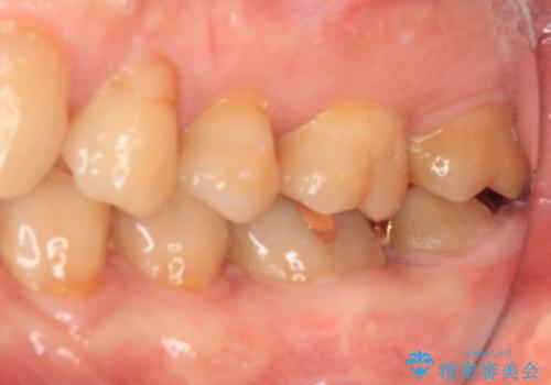 欠けてしまった奥歯のむし歯治療の治療前
