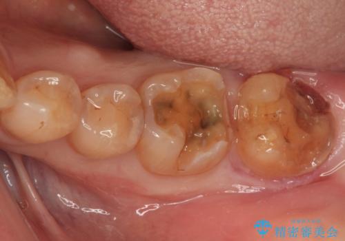 欠けてしまった奥歯のむし歯治療の治療中