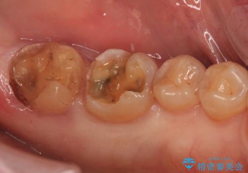 欠けてしまった奥歯のむし歯治療の治療中