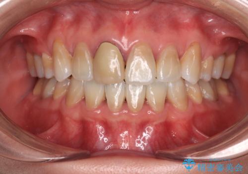 適合の悪い保険診療のクラウンをオールセラミッククラウンにの治療前