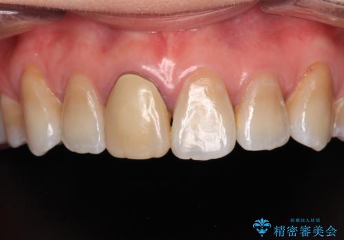 適合の悪い保険診療のクラウンをオールセラミッククラウンにの症例 治療前