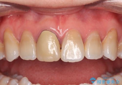 適合の悪い保険診療のクラウンをオールセラミッククラウンにの治療前
