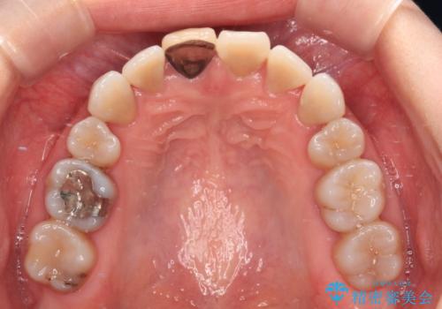 適合の悪い保険診療のクラウンをオールセラミッククラウンにの治療前