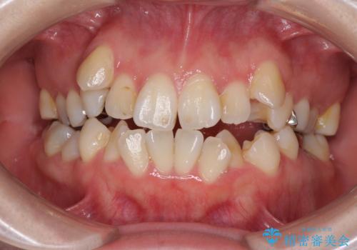 インビザラインが続けられない　装置変更して抜歯矯正の症例 治療前