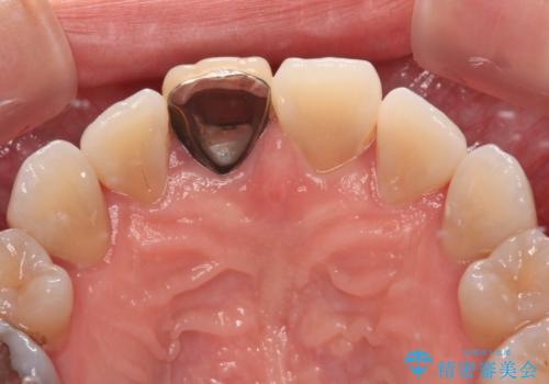 適合の悪い保険診療のクラウンをオールセラミッククラウンにの治療前