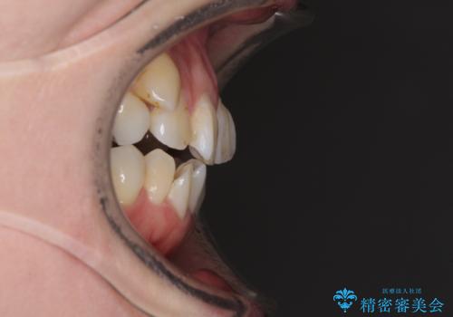 インビザラインが続けられない 装置変更して抜歯矯正の治療前