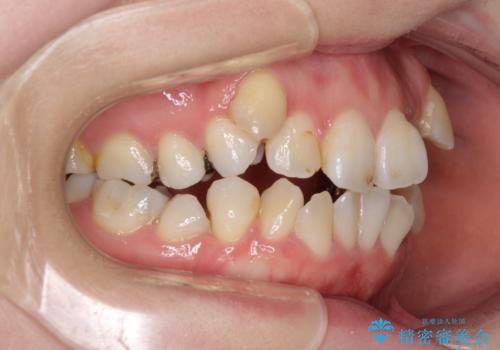 インビザラインが続けられない　装置変更して抜歯矯正の治療前