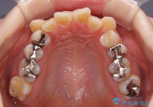 インビザラインが続けられない　装置変更して抜歯矯正の治療前