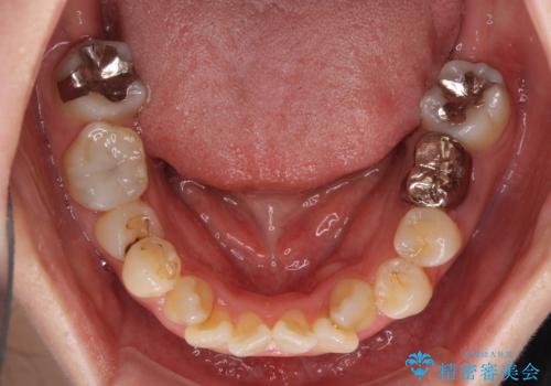インビザラインが続けられない 装置変更して抜歯矯正の治療前