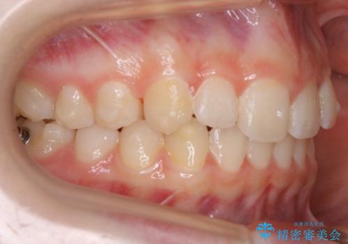 【非抜歯】前歯のガタつきを改善　笑顔の印象も変わる!の治療中