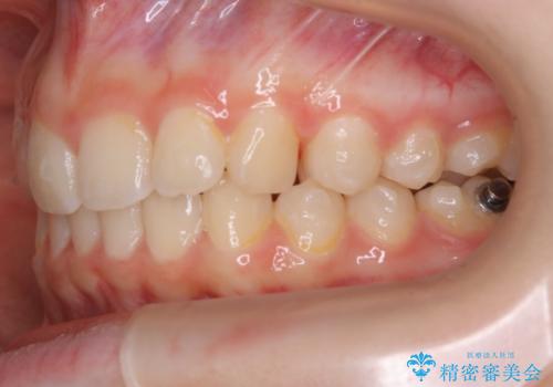 【非抜歯】前歯のガタつきを改善　笑顔の印象も変わる!の治療中