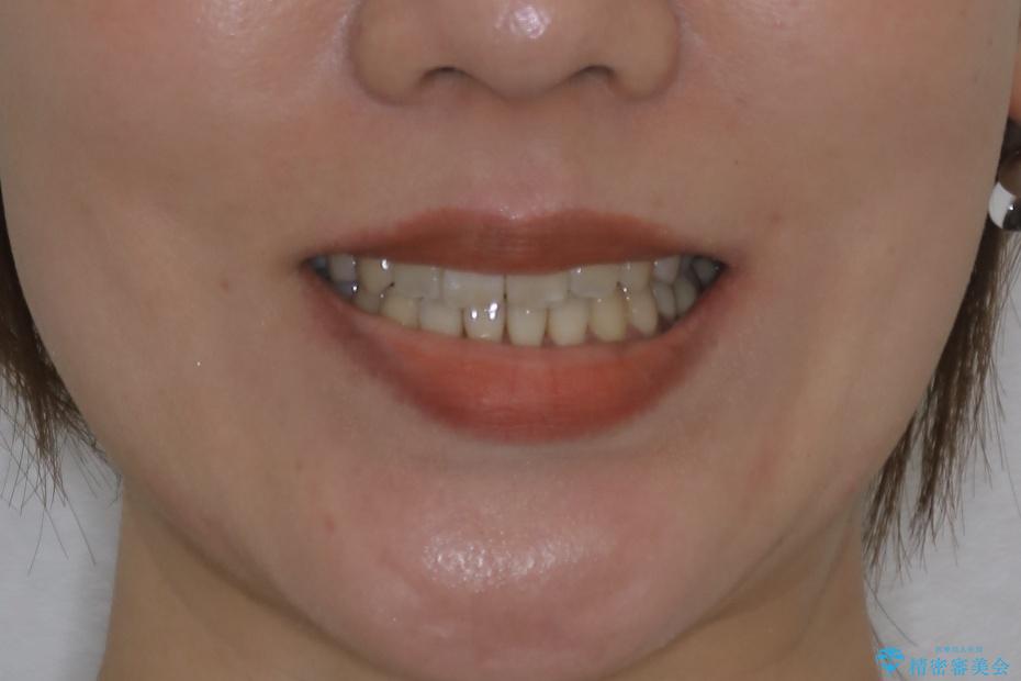 【非抜歯】20代女性　歯のガタつきと噛み合わせの治療の治療後（顔貌）