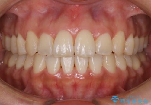【非抜歯】20代女性　歯のガタつきと噛み合わせの治療の症例 治療後