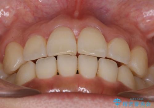 【非抜歯】20代女性 歯のガタつきと噛み合わせの治療の治療後