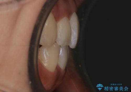 【非抜歯】20代女性 歯のガタつきと噛み合わせの治療の治療後