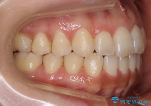 【非抜歯】20代女性　歯のガタつきと噛み合わせの治療の治療後