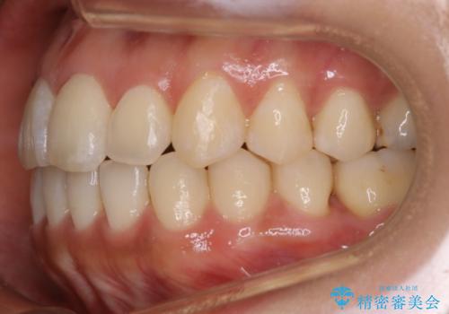 【非抜歯】20代女性 歯のガタつきと噛み合わせの治療の治療後