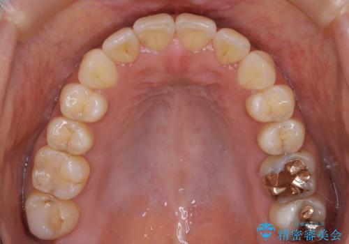 【非抜歯】20代女性 歯のガタつきと噛み合わせの治療の治療後