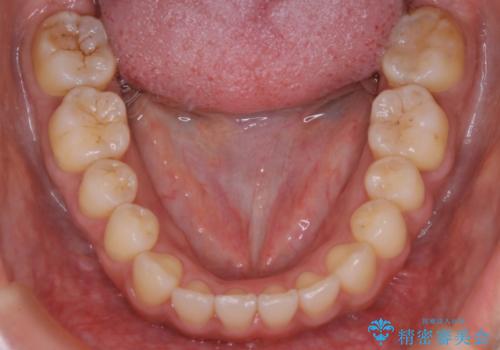 【非抜歯】20代女性　歯のガタつきと噛み合わせの治療の治療後